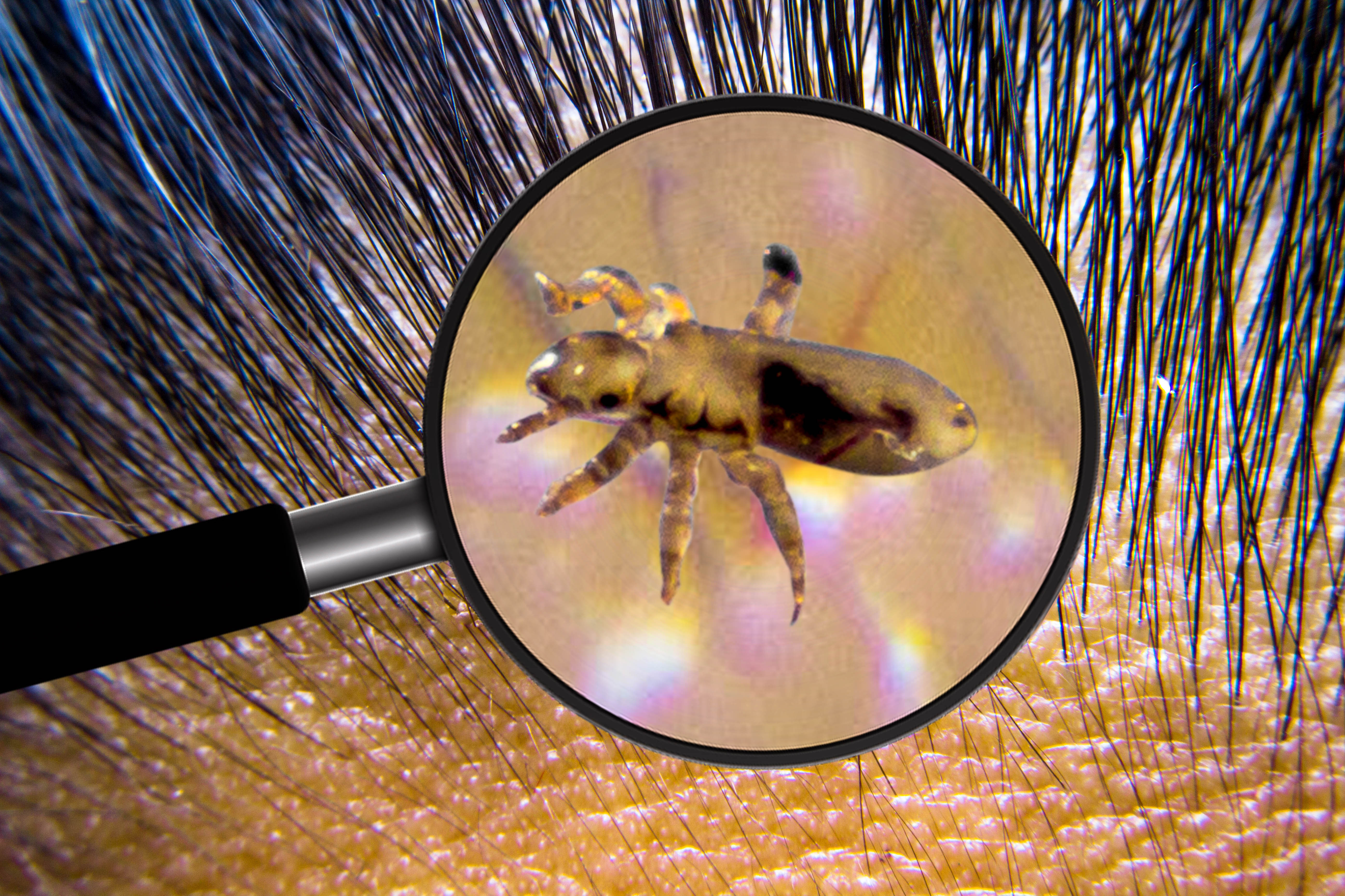 Lice